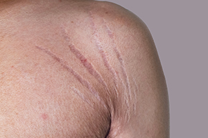 Scarring and Disfigurement